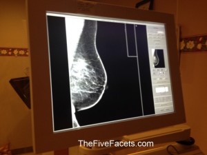 My Left Breast Mammogram Image